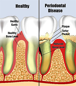 periodontal-diseases